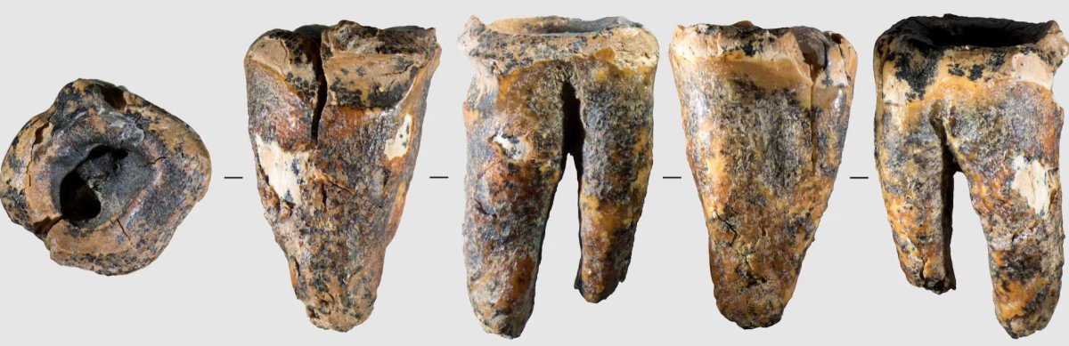 Sibirya mağarasında bulunan diş, Neandertal diş cerrahisini ortaya koydu