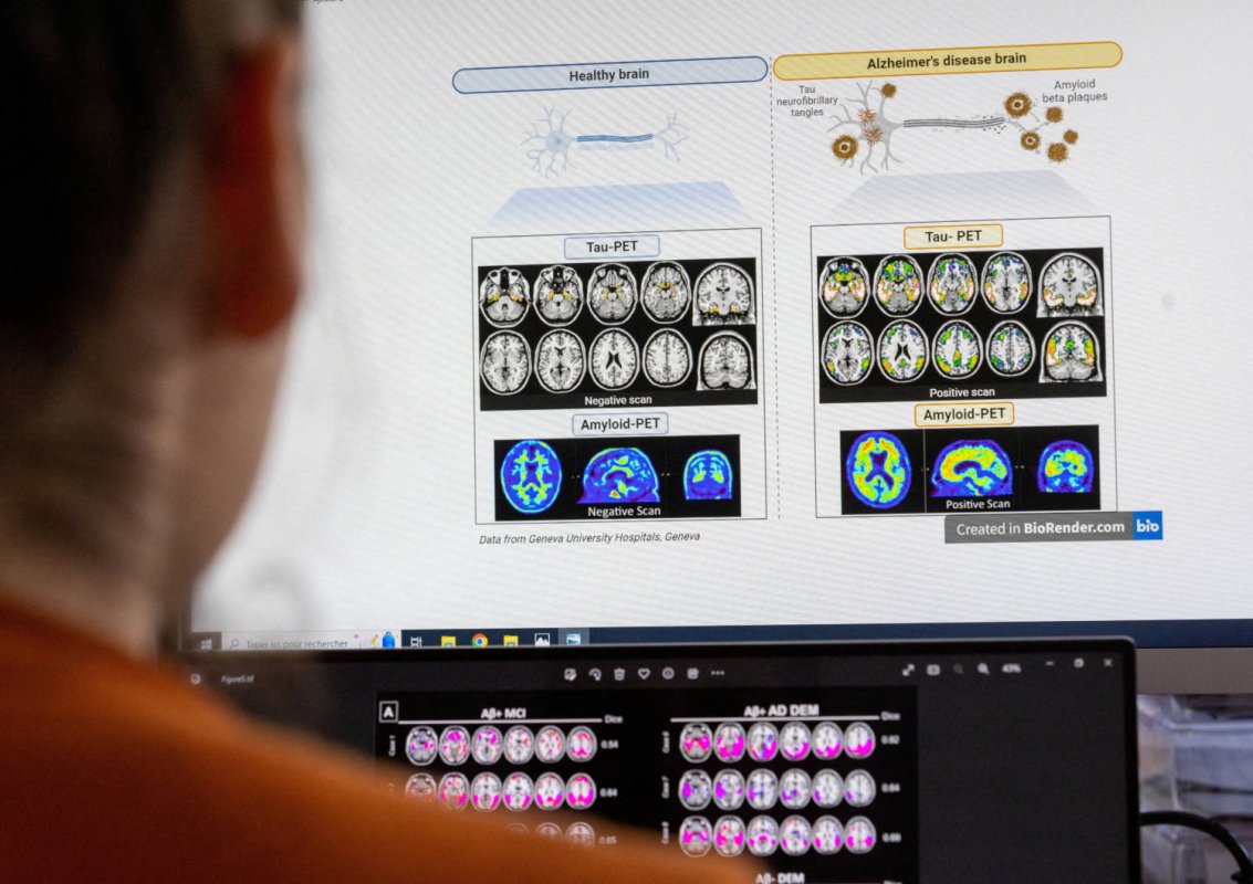 WHO'dan çarpıcı açıklama: Güney Kıbrıs'ta kadınların en büyük ikinci ölüm nedeni Alzheimer